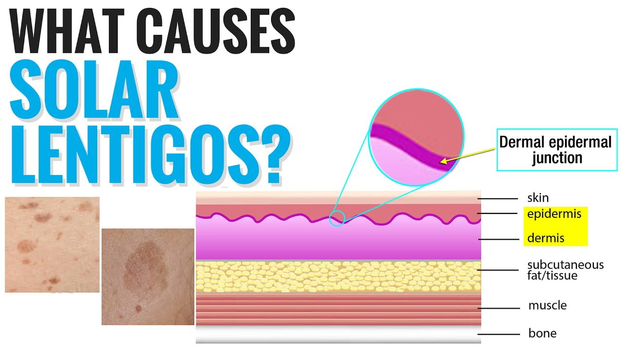 孚立美“氟轻松氢醌维A酸乳膏”能用于老年斑治疗吗？