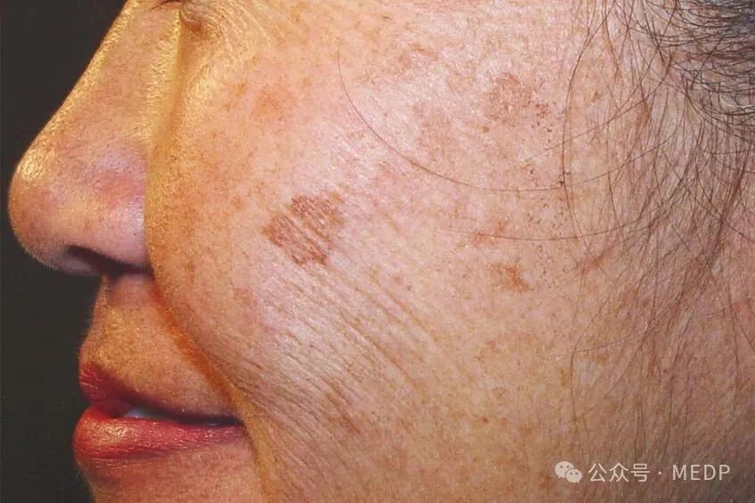 老年斑、晒斑、日光性雀斑是一回事吗？